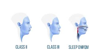 Orthognathic Surgery Explained [upl. by Anelehs]