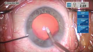 TBWTDCS 209 How to Identify Weak Zonules Gentle Capsule Tension Ring Placement Technique Hydrus [upl. by Cutter17]