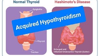 Chronic lymphocytic thyroiditis Hashimoto Thyroiditis or Autoimmune Thyroiditis [upl. by Jenna]