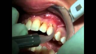 PHILIPS LASERS Gingivectomiewmv [upl. by Cirek]