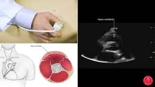 parasternal kortakse høy aorta g pulmonalklaffene [upl. by Henry271]