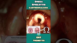 Omega Epiglottis in Laryngomalacia made easy for USMLE NEET PG INCET NCLEX [upl. by Noby]