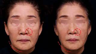 Thread Lift  facelift [upl. by Aisinut751]