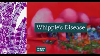 Whipples Disease [upl. by Seravat]