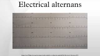 Electrical alternans [upl. by Norvan]