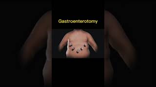 Gastroenterostomy [upl. by Aicemed]