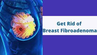 Breast Fibroadenoma Treatment Without Surgery in Hyderabad  VABB Treatment [upl. by Ahsieat264]