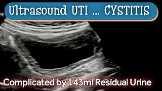 Cystitis  UTI  Ultrasound  Diagnosis [upl. by Rorie21]