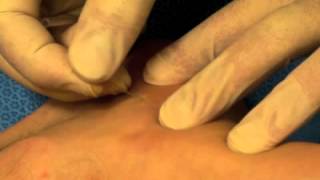 Dry needling for treatment of plantar fasciitis [upl. by Sakram]