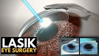 Lasik Eye Surgery Everything You Need to Know [upl. by Zorana677]