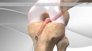 ACL Reconstruction [upl. by Ma]