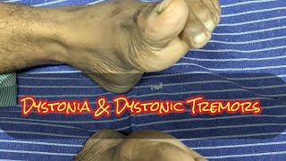 Dystonia Dystonic Tremors Extrapyramidal manifestations STRIATAL TOE [upl. by Norval]