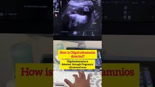 Reduced Liqour amnii during pregnancy What to doDr Sunil Kumar G Samnioticfluid amniocentesis [upl. by Hahnert]