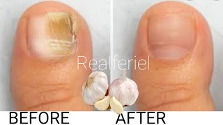 Soigner la mycose des ongles naturellement  Vous devez tester cette astuce [upl. by Githens]