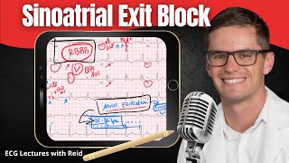 Sinoatrial SA Exit Block EKG  ECG Lecture [upl. by Akered120]