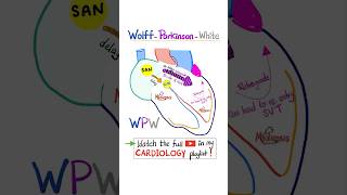 Cardiac Arrhythmia WolffParkinson White WPW Syndrome science cardio nurse doctor mbbs [upl. by Aikemet]