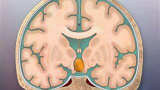 Transcallosal TC Surgical Approach to Hypothalamic Hamartomas [upl. by Enelyak]