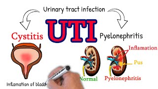 Cystitis  made simply UTI Cystitis vs pyelonephritis [upl. by Ecinej]