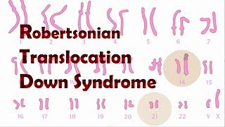 Robertsonian Translocation Down Syndrome ROB [upl. by Lemuelah]