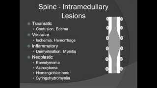 Localization of Spinal Masses  Introduction [upl. by Konstance226]