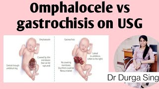 Omphalocele vs gastrochisis on USG [upl. by Islek]