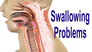 Swallowing Problems or Dysphagia Top 4 Possible Causes Including Cricopharyngeal Dysfunction CPD [upl. by Ariane]