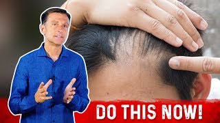 Receding Hairline Causes And Remedies – DrBerg [upl. by Zeni]