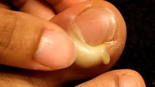 Paronychia What Are Nail Infections [upl. by Combs743]