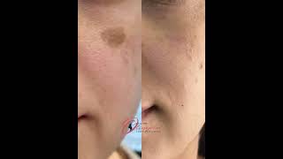 Laser birthmark removal  Cafeaulait laserexpert olimpiacarmen beforeandafter darkspotsonface [upl. by Adnohral]