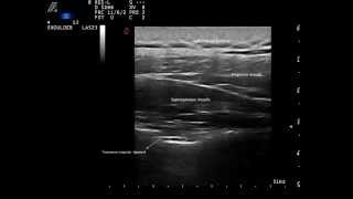 Ultrasound guided suprascapular nerve block by Murat Karkucak MD [upl. by Faxun]