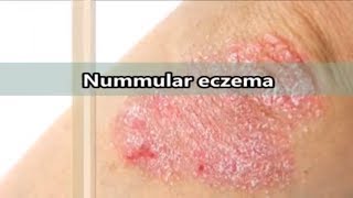 Nummular eczema what is nummular eczema [upl. by Steen]