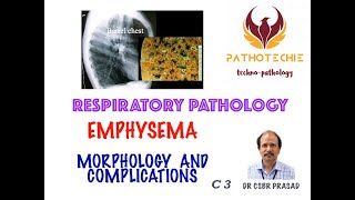 Emphysema  Morphology and Complications [upl. by Matronna12]