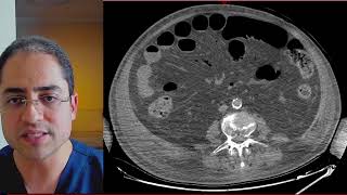 Qual o passo a passo para dar diagnóstico de isquemia mesentérica na TC de Abdome [upl. by Eneja]