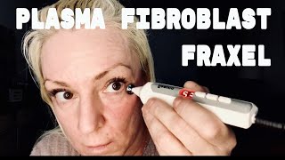 PLASMA FIBROBLAST FRAXEL  At home skin tightening [upl. by Friedly924]