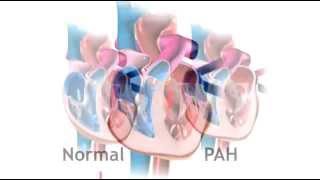 Pulmonary Arterial Hypertension [upl. by Kono]