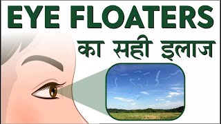 Eye Floaters  Cause amp Treatment  Risks amp Management of Eye Floaters आई फ्लोटर्स को कैसे ठीक करें [upl. by Baggs557]