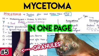 Mycetoma explained in simplified way with mnemonic 🤯  mycology microbiology MCWA [upl. by Wamsley]