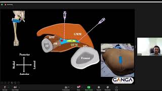 Sciatic Nerve Block  Proximal Approach  Distal Approach  PNS  IDRA  Ultrasound  DrTuhinM [upl. by Camus904]