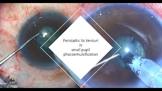 The Peristaltic Vs the Venturi machine in small pupil phacoemulsification [upl. by Radloff]