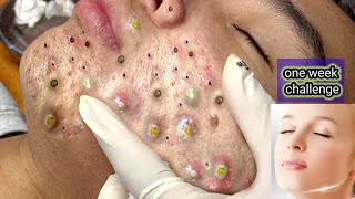 blackhead removal facial at homeBest Treatment acneblackheadhow to remove pimpleacneblackheads [upl. by Hynda591]