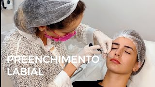 Preenchimento Labial com Ácido Hialurônico [upl. by Rutan807]