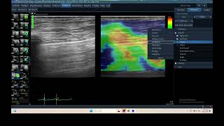 IQ 320 TFAST LUNG ULTRASOUND ECHOPAC ANALYSIS 3 ELASTOGRAPHY [upl. by Azriel]