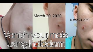 Vanish your mole  Using HALODERM [upl. by Eedrahc]