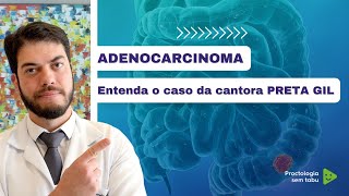 Entenda o caso da cantora Preta Gil Adenocarcinoma de cólon Câncer de intestino [upl. by Claudio]