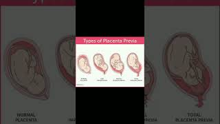 Types of placenta previa implantation  bleeding 🩸knowledge medical shortvideo share [upl. by Hanikehs119]