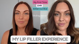 My Lip Filler Experience  What To Expect When Healing  05ml or 1ml [upl. by Ahsitul]