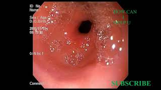 PAN GASTRITIS ANTRAL GASTRITIS FUNDAL EROSION அல்சர்வயிற்றுப்புண் [upl. by Asirral375]