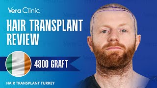 Hair Transplant Review Turkey Istanbul 4800 Grafts hairtransplantturkey hairtransplantreview [upl. by Thurnau]