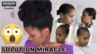 SOLUTION MIRACLE contre lALOPÉCIE [upl. by Yrellav]