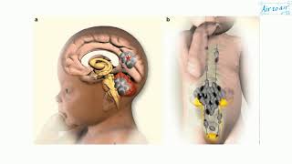 medulloblastoma [upl. by Patrizio]